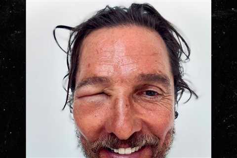 Matthew McConaughey Shares Selfie Of Bee Sting, Eye Swollen Shut