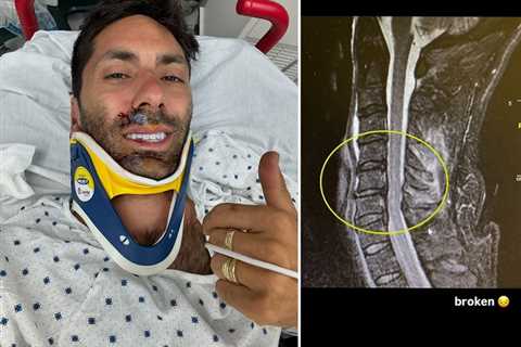 Nev Schulman Breaks Neck in Bike Accident