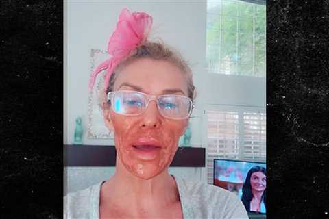 Brandi Glanville Burns Face With Nair While Battling Facial Parasite