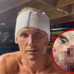 Surfer Jamie Mitchell Suffers Gruesome Cuts in Freak Wipeout