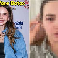 Viral Podcaster Bobbi Althoff Showed The Botched Botox That Left Her Face Paralyzed