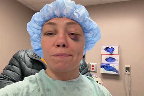 UFC star Rose Namajunas won’t be able to blow nose, sneeze for three months after gruesome injury