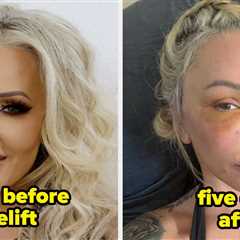 16 Celebs Who Admitted To Getting Facelifts (And How They Look Now)