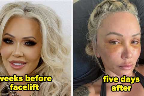 16 Celebs Who Admitted To Getting Facelifts (And How They Look Now)