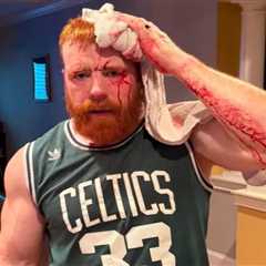 WWE star Sheamus shows off gruesome head injury in bloody ‘gym fail’